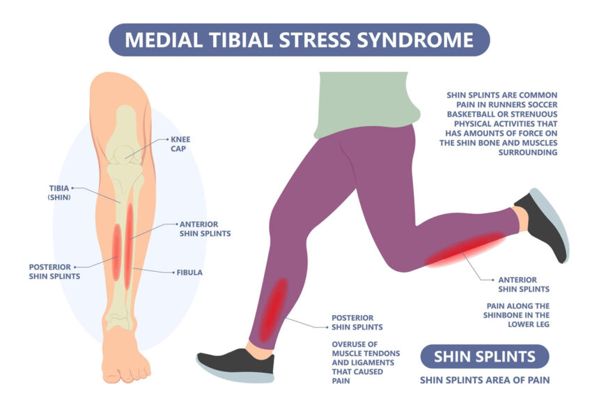 Compression Socks for Shin Splints