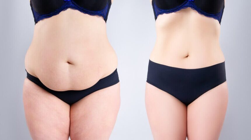 Tummy Tuck Procedure