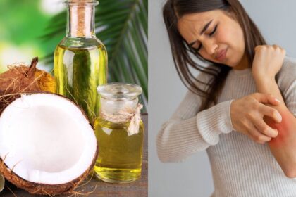 Coconut oil: Is it an effective home remedy for psoriasis?