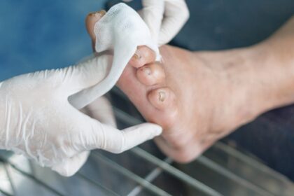 Diabetic Charcot Foot: Causes, Diagnosis, and Treatment