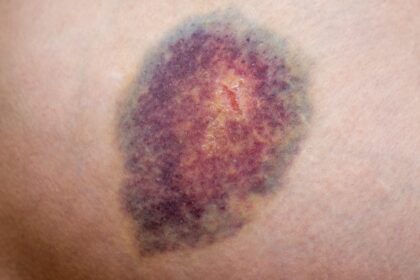 Does Diabetes Make You Bruise Easily?