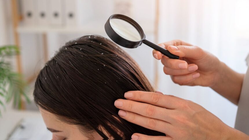 Home remedies for dandruff: Try eggs and yoghurt to soothe itchy scalp