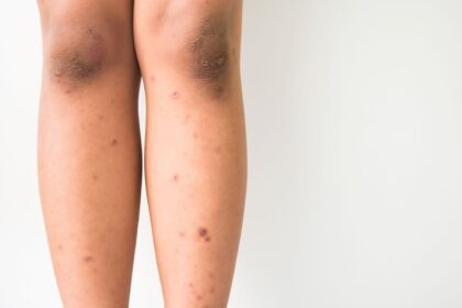 Dark spots on legs: 4 reasons why you have these and how to get rid of them