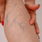 Can Medical Compression Socks Help with Varicose Veins? What You Need to Know