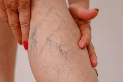 Can Medical Compression Socks Help with Varicose Veins? What You Need to Know