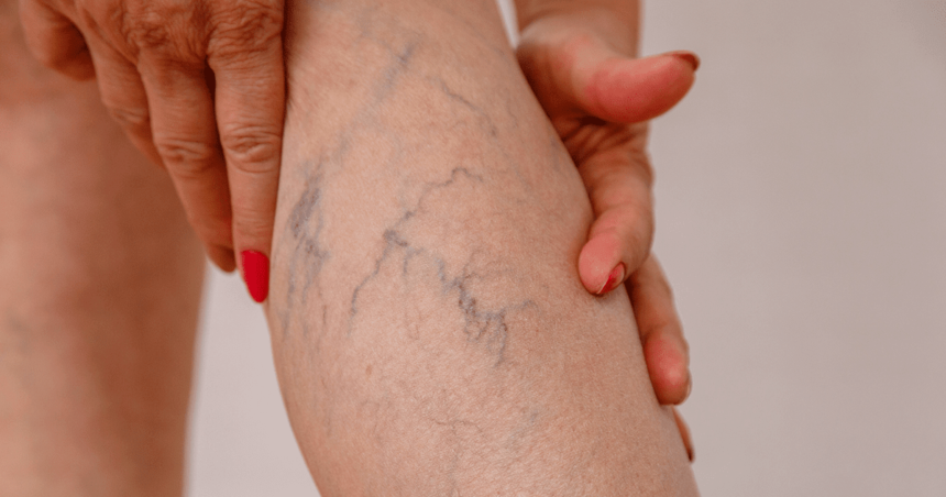 Can Medical Compression Socks Help with Varicose Veins? What You Need to Know